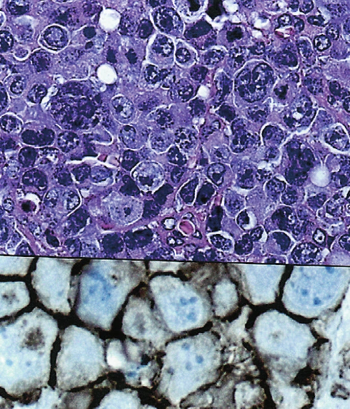 (a). Difuzní velkobuněčný B lymfom, anaplastická varianta. (HE, 400krát) (b). Pozitivní nález s protilátkou CD20. (400krát)