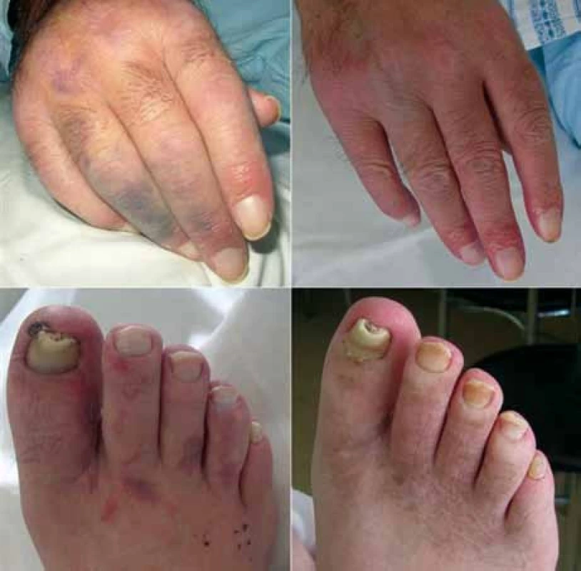 Kožní projevy u pacienta v průběhu léčby režimem R-CHOP uzavřeny jako vaskulitida při základní diagnóze (fotografie vlevo). Reziduální hyperpigmentace je patrná na chodidlech (obrázky vpravo pořízeny s odstupem 1 roku).