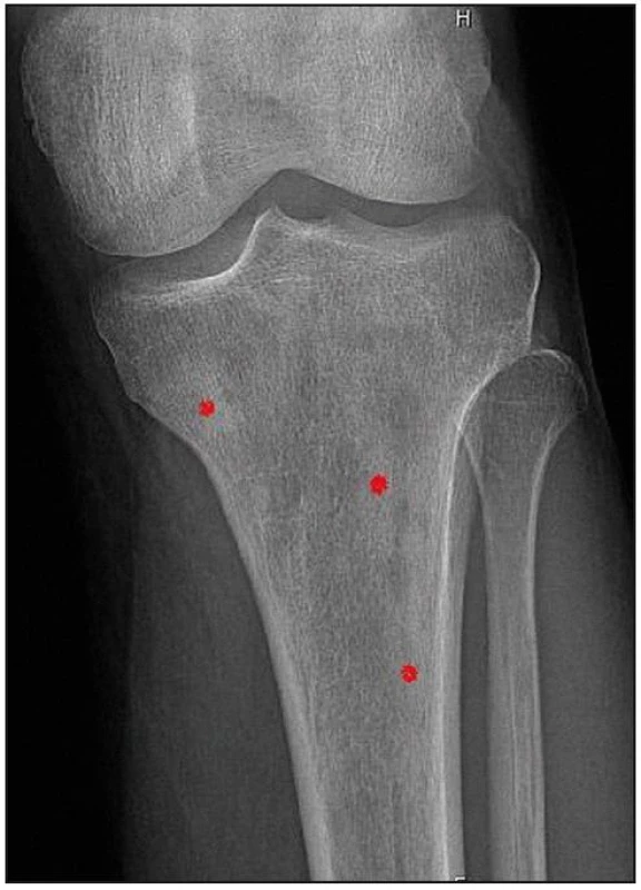 Zobrazení tibie metodou klasické radiografie. Zřetelné osteosklerotická ložiska.
