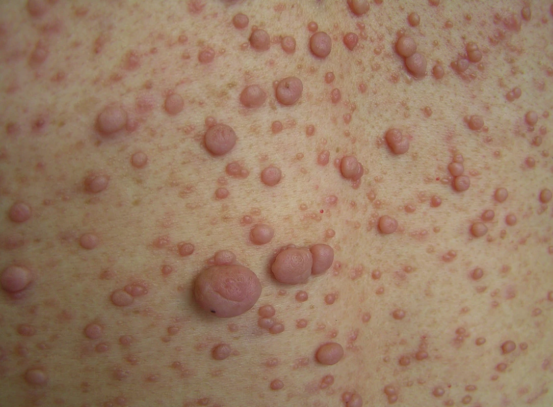 Kožní neurofibromy – detail mnohočetných kožních neurofibromů na zádech