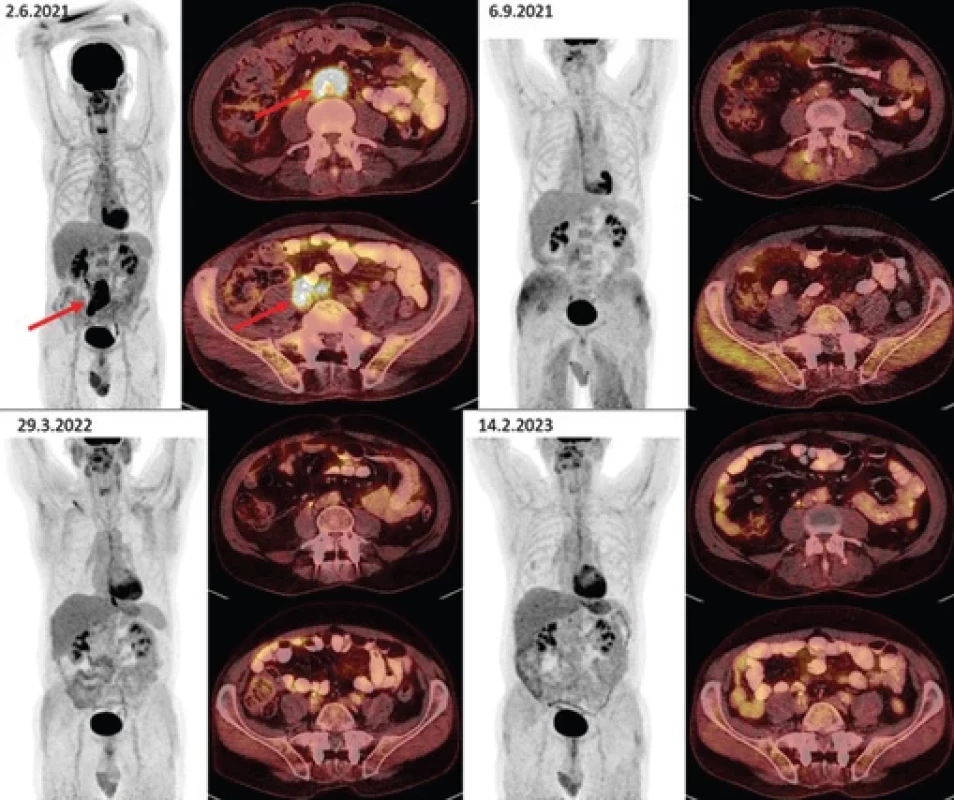 Vývoj retroperitoneální fi brózy při zobrazení metodou FDG-PET/CT.