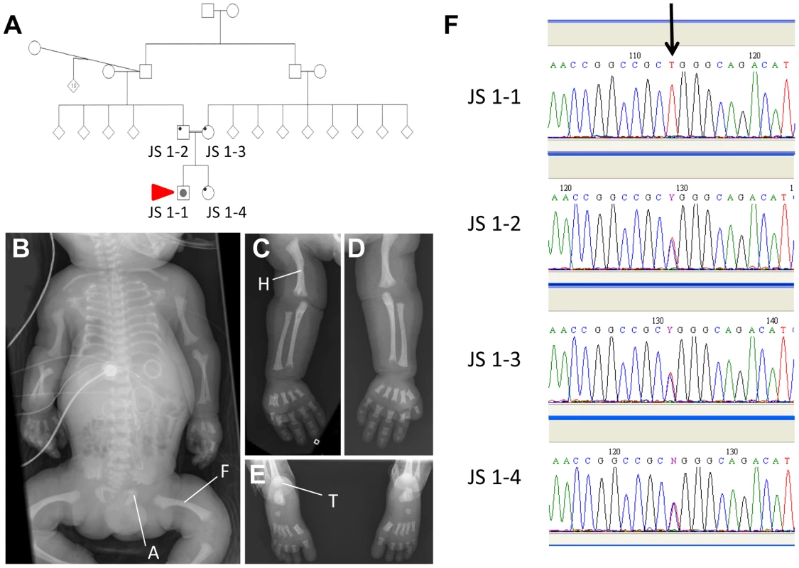An <i>IFT140</i> mutation identified in a Jeune Syndrome patient.