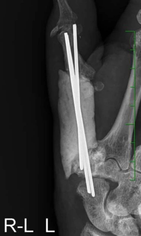 Rtg: rekonstrukce záprstní kosti palce levé ruky cementovým spacerem s třemi Kirschnerovými dráty (jeden rok po reoperaci)
Fig. 2. X-ray of the reconstructed metacarpal bone of the left thumb with a cement spacer and three Kirschner wires (one year after reoperation)