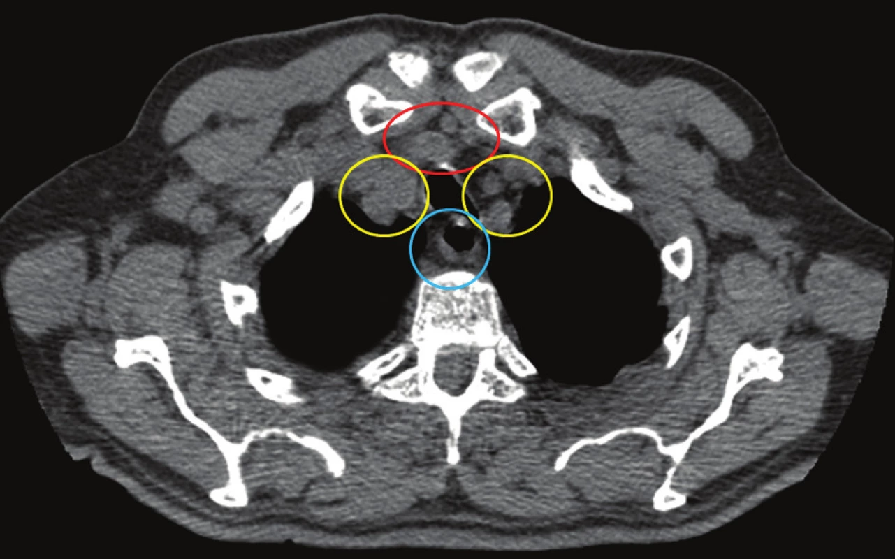 Šíření infekce na krku probíhá ve třech anatomických prostorech
Fig. 3. Spread of infection on the neck concerns three anatomical spaces