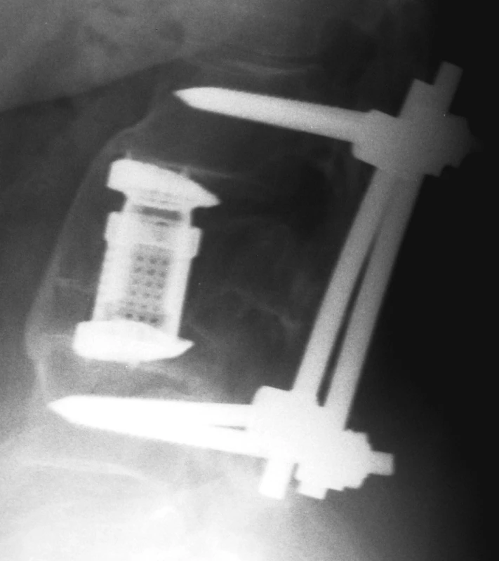 Vhojený koš Synex, přední intersomatická fúze
Pic. 5. Healed-in Synex cage, anterior intersomatic fusion