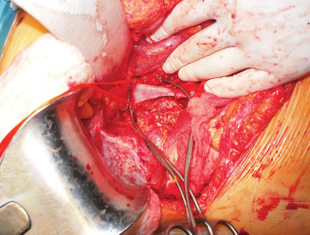 Stav po odstranění tumoru i s přední stěnou v. cava inf., do které prorůstal
Fig. 6: Tumor resected along with the anterior wall of inferior caval vein