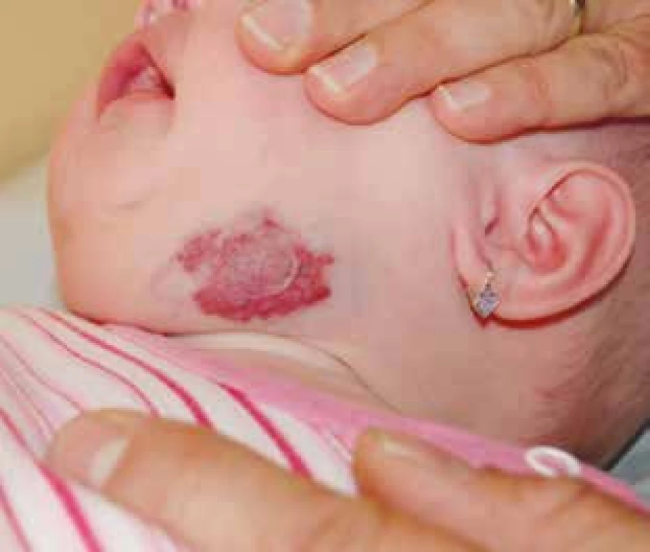 Smíšený podčelistní infantilní hemangiom.
Fig. 4. Mixed submandibular infantile hemangioma.