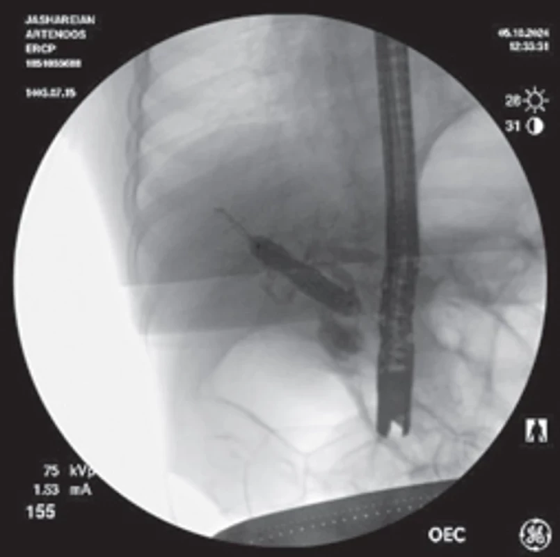 A 4-year-old female patient with a post-partial OLT stricture (patient 4). Sequential dilation with a 3-mm coronary balloon and a TTS balloon enabled the deployment of dual plastic stents, restoring bile flow.   Obr. 4. Čtyřletá pacientka se strikturou po parciální OLT (pacient 4). Sekvenční dilatace 3mm koronárním balónkem a TTS balónkem umožnila zavedení dvou plastových stentů, čímž se obnovil průtok žlučí.