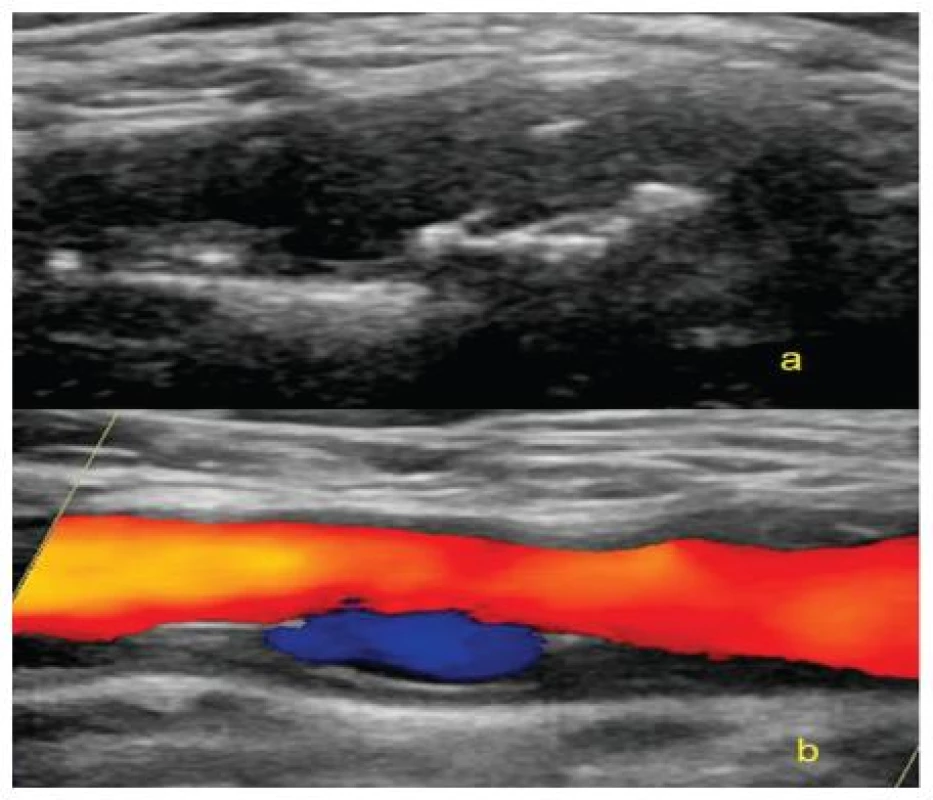 Exulcerovaný plát v bifurkaci karotid v ultrasonografickém obrazu – zobrazení v B-modu (a), zobrazení v barevném modu (b)