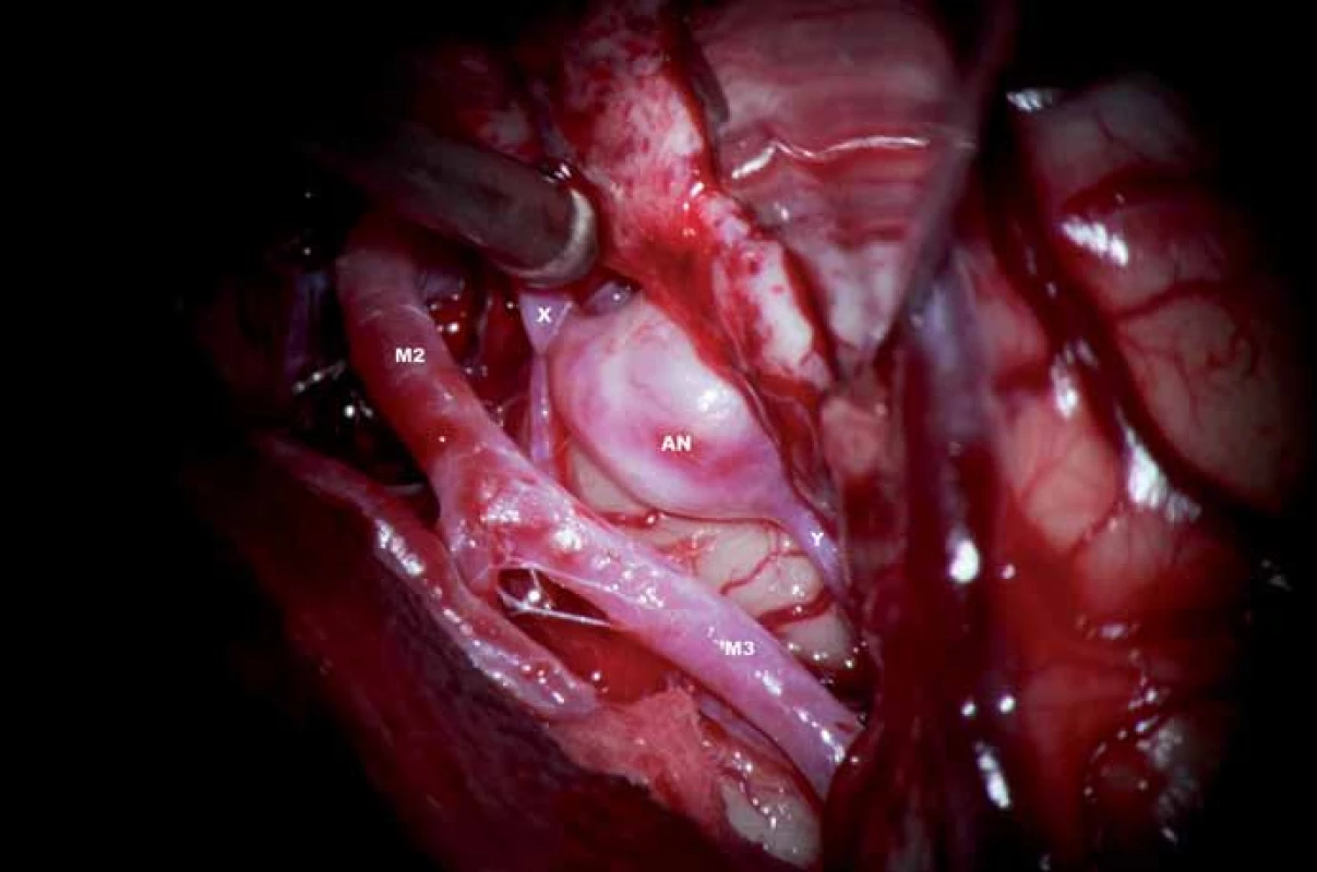 Aneuryzma je spojeno širokým krčkem s mateřskou tepnou. Vlastní fundus je kryt temporálním operkulem.
AN – aneuryzma, x – přítoková část tepny, y – odtoková část tepny, M2 – větev a. cerebri media, M3 – větev a. cerebri media distální.