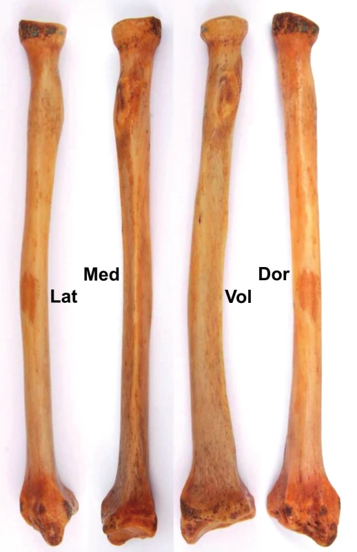 Radius (pravá strana): Lat – laterální plocha, Med – mediální plocha, Vol – volární plocha, Dor – dorzální plocha.
Fig. 2: Radius (right side): Lat – lateral surface, Med – medial surface, Vol – volar surface, Dor – dorsal (posterior) surface.