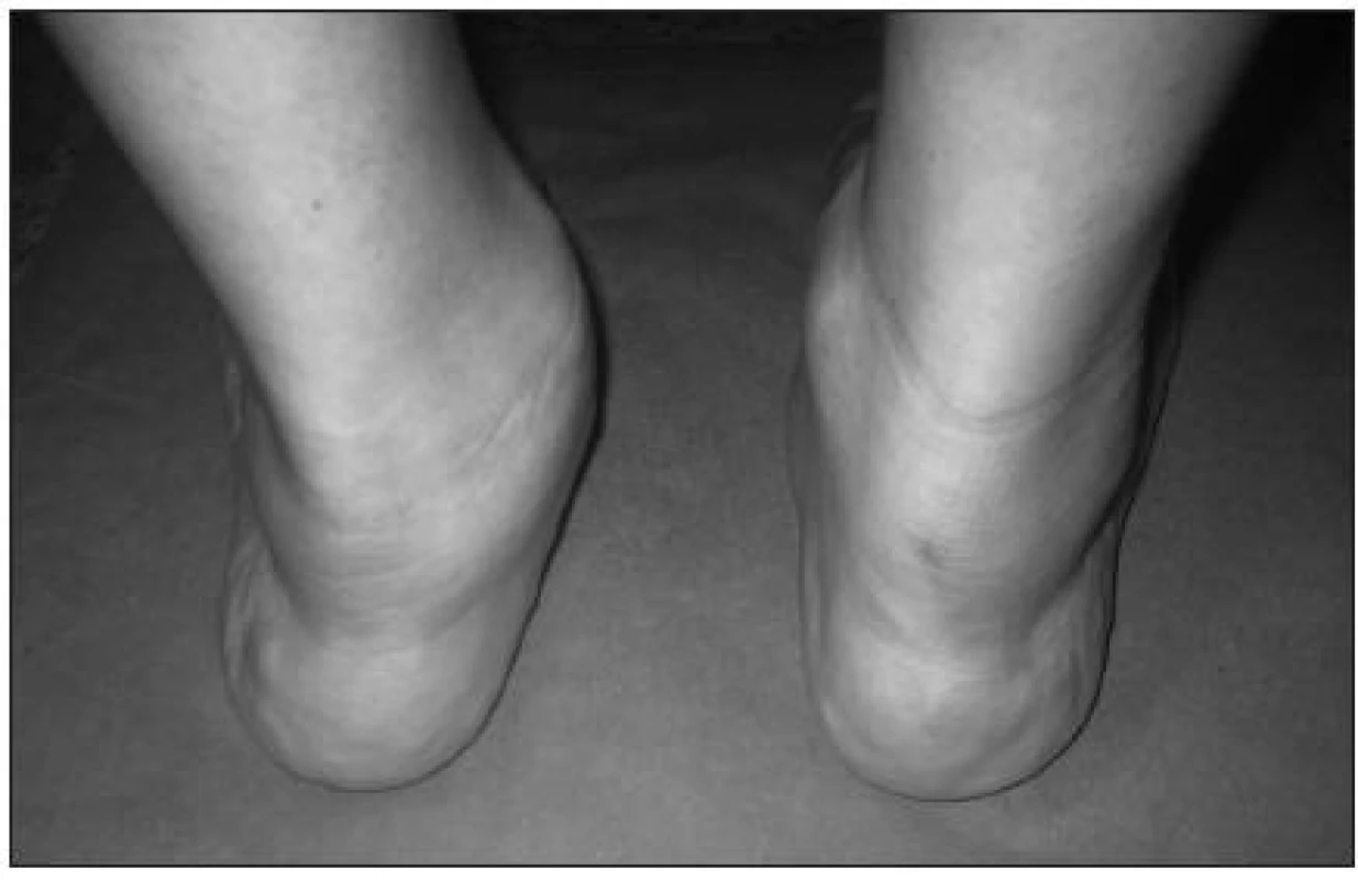 Levostranná planovalgózní deviace nohy, známky ruptury šlachy m. tibialis posterior.
