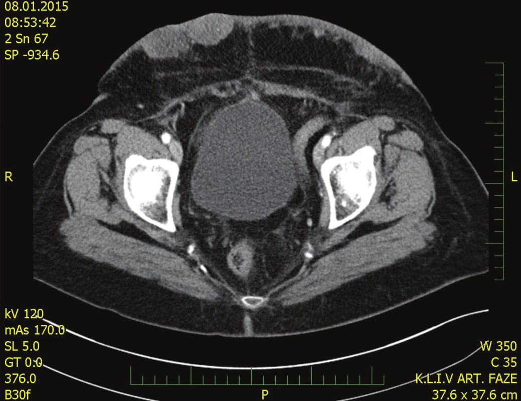 Předoperační CT břicha
Fig. 1. Preoperative CT scan of the abdomen
