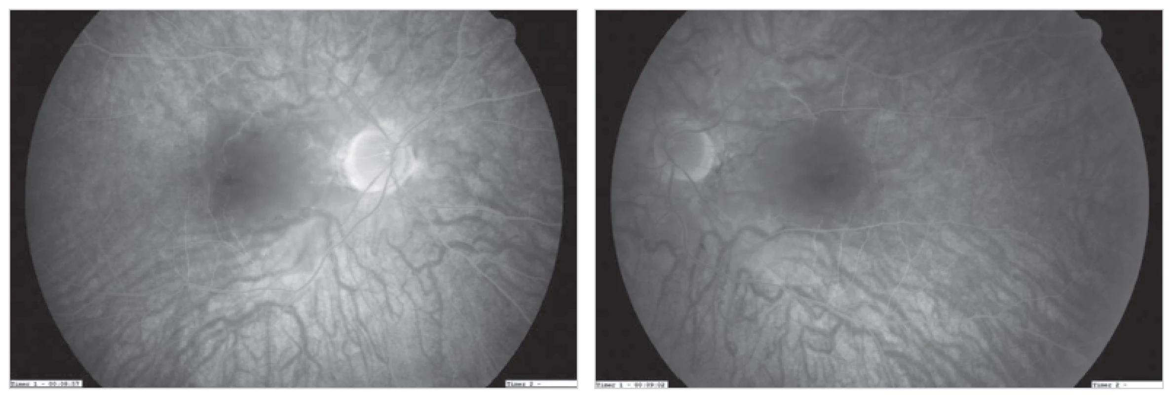 Fluorescenčná angiografia – oklúzia arteria centralis retinae bilateralis, cieva je bez perfúzie aj po 10 minúte
Fig. 2: Fluorescence angiography – bilateral central retinal artery occlusion; perfusion loss of the vessels even after 10 minutes