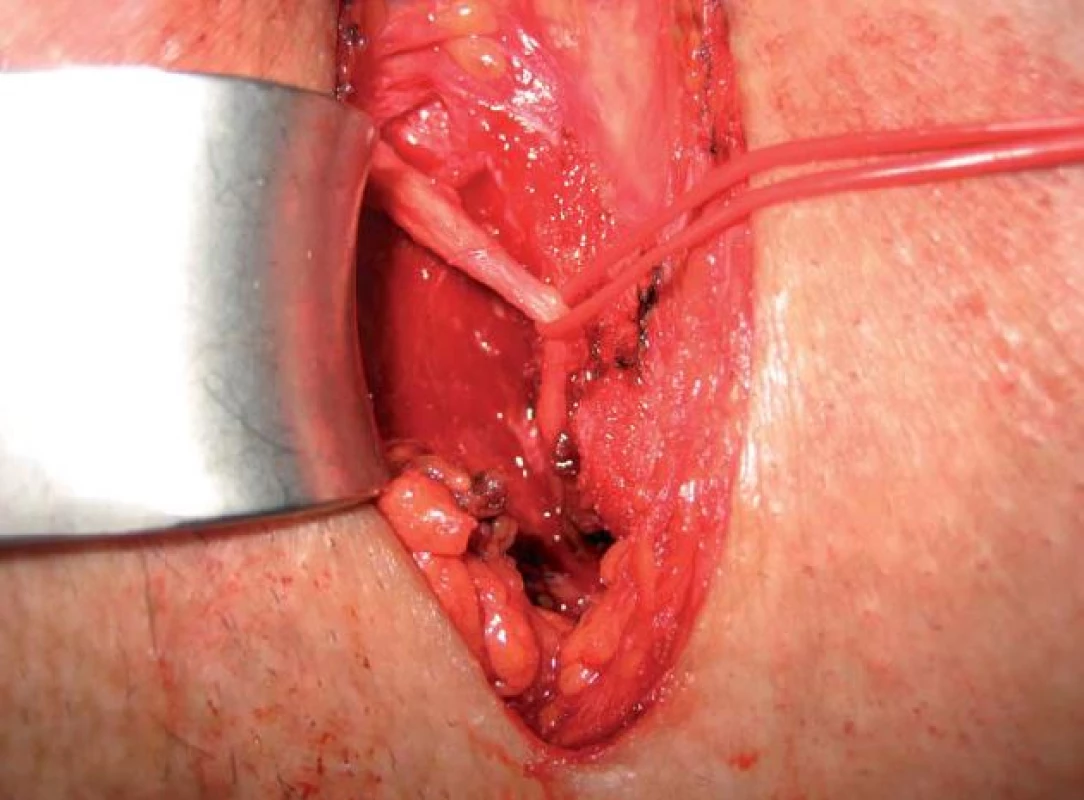 Deliberační operace n. pudendus (Klinika rekonstrukční a plastické chirurgie, Vídeň).