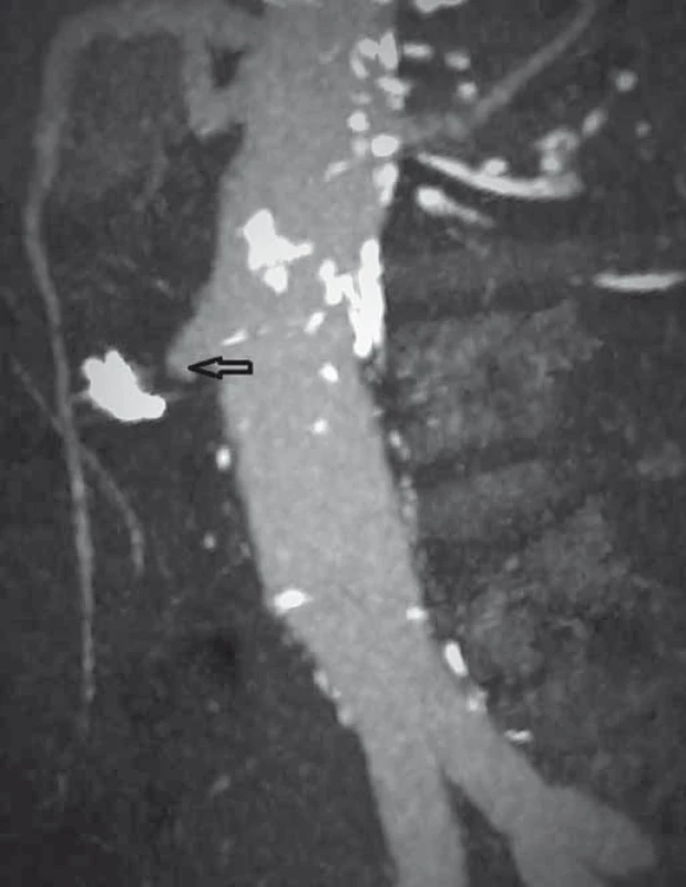 CT angiografie, frontální zobrazení, venózní fáze (šipka ukazuje píštěl).
Fig. 5. CT angiography, frontal view, venous phase (the arrow points to the fistula).