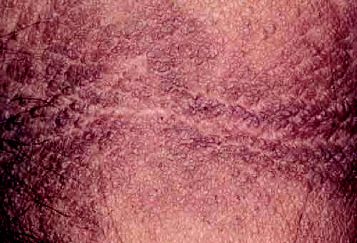 Acanthosis nigricans – axillární oblast