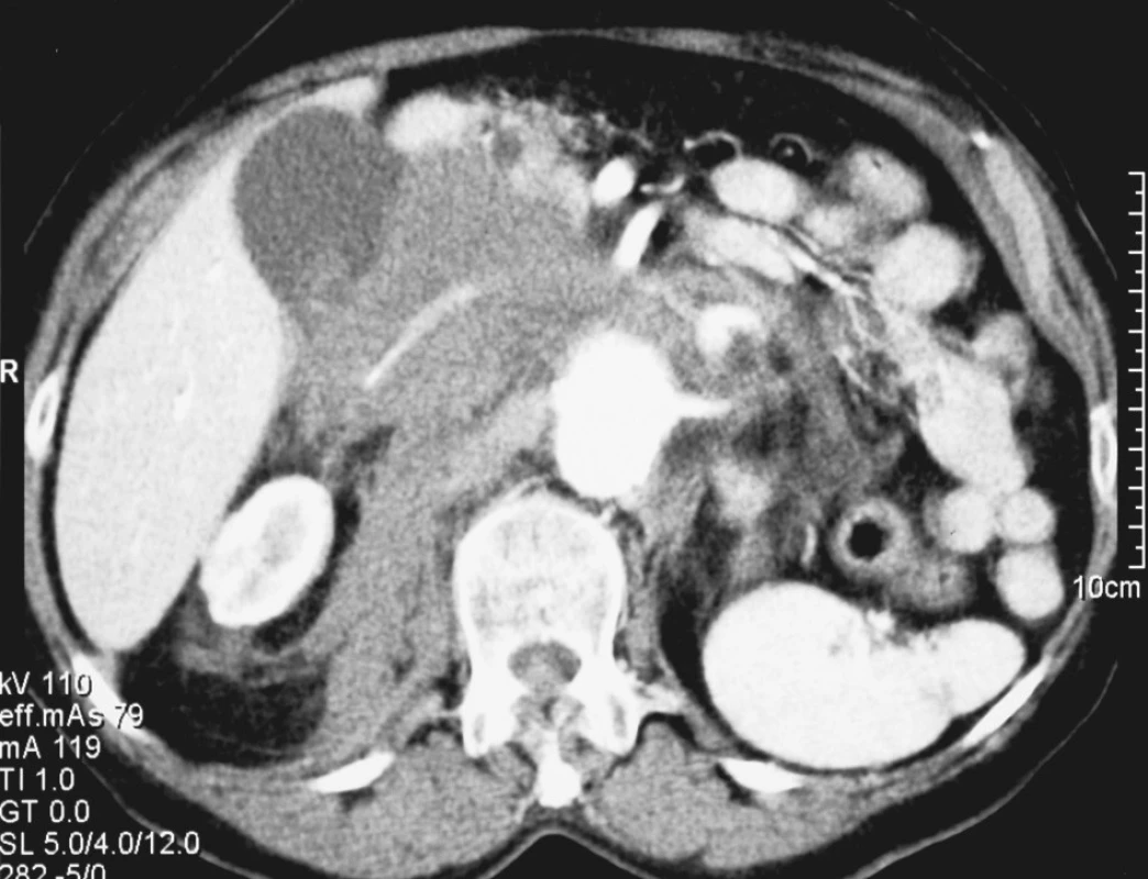 3. Rupturované velké juxtarenální AAA u 82leté nemocné
Fig. 3. Ruptured large juxtarenal AAA in a 82-year old female patient