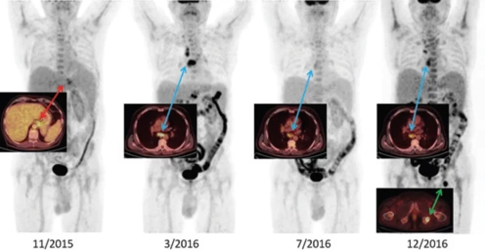 Vývoj nemoci v FDG-PET/CT obraze.
