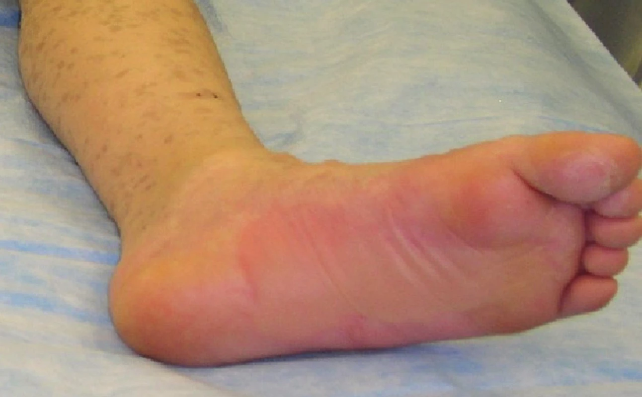 Naplněné buly na plosce levé nohy
Fig. 5: Filled bullae on the sole of the left foot