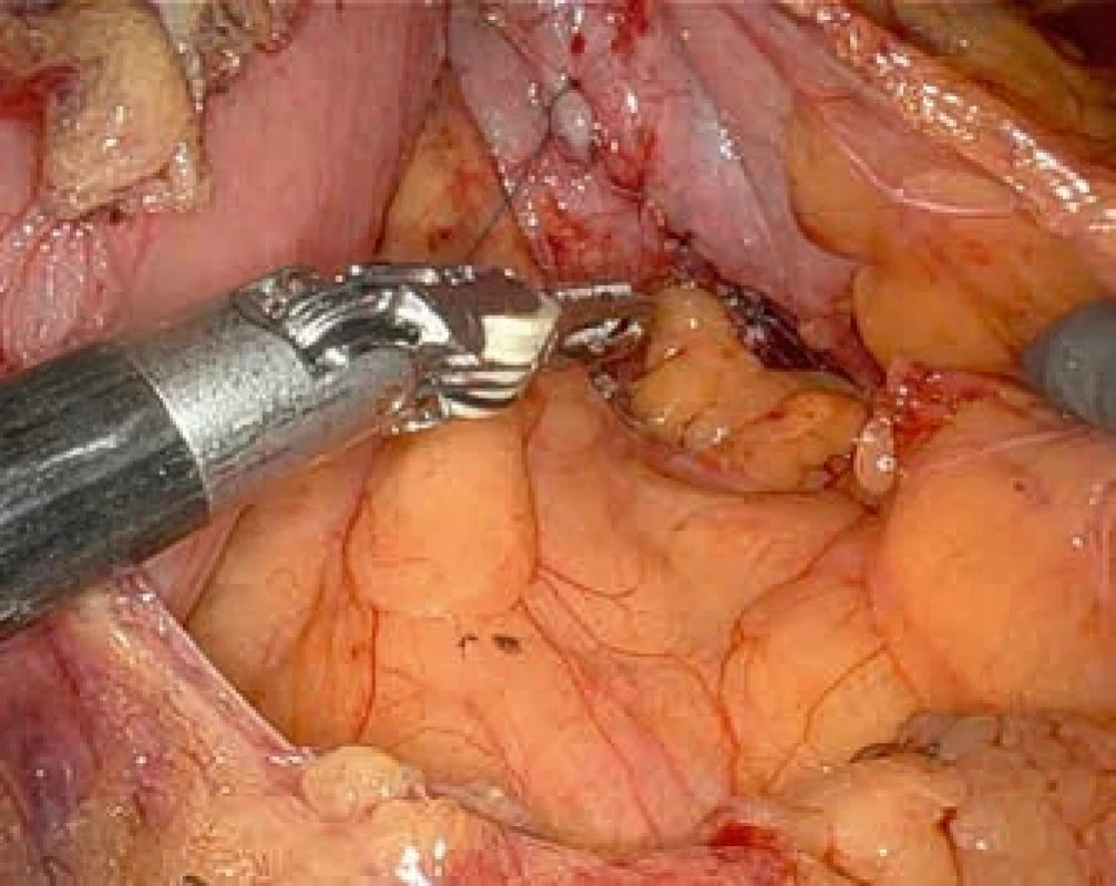 Definitivní ošetření resekční linie po snesení divertiklu samofixačním stehem. Definitive treatment of the resection line after resection of the diverticulum using barbed suture.