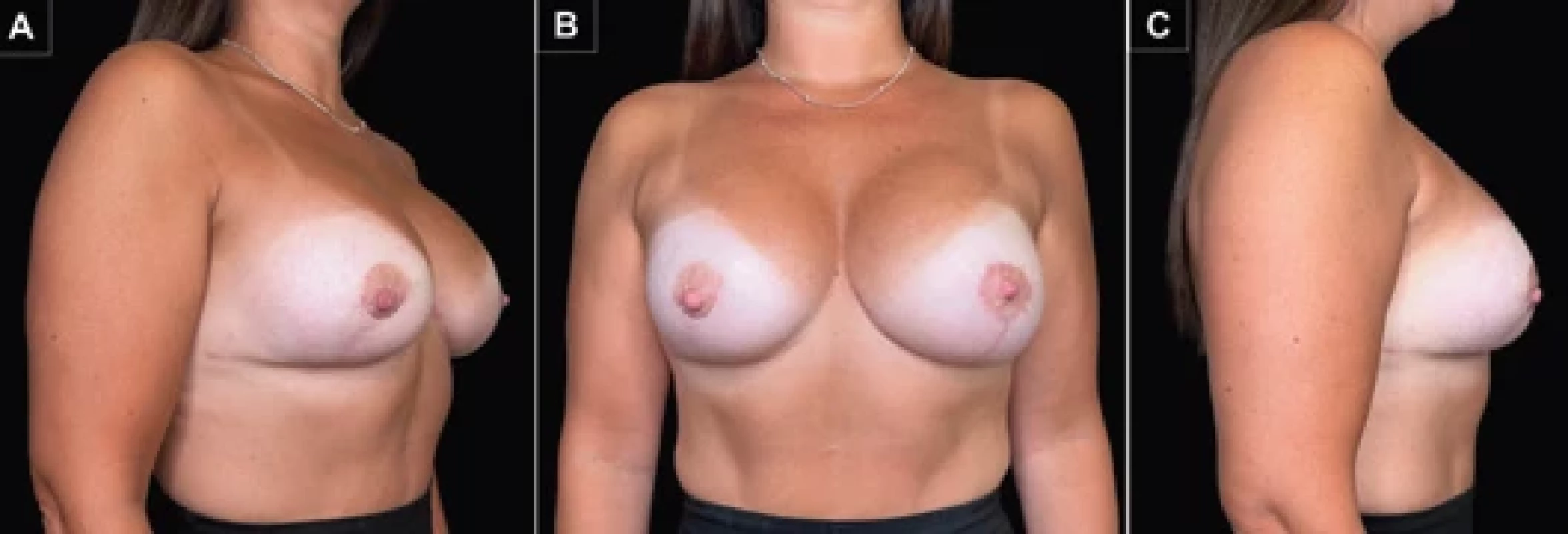 Postoperative image at 12 months of follow-up. A) Right oblique view; B) front view; C) right side view.