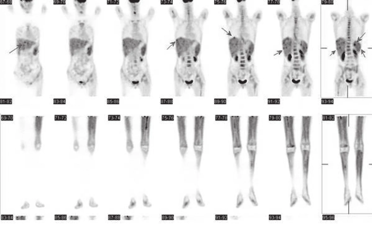nímky PET/CT zapůjčeny z Masarykova onkologického ústavu Brno, vyšetření ze dne 1. 6. 2012 (nález po 2. bloku chemoterapie), po aplikaci <sup>18</sup>F-FDG i. v., po 60-ti minutách, snímání emisních a transmisních skenů s korekcí absorpce a iterativní rekonstrukcí dat. Snímání od proximální části stehen výše (horní část obrázku). Snímání dolních končetin (dolní část obrázku). Low dose CT ke korekci atenuace. Zjištěna výrazně nehomogenní až drobně ložisková distribuce metabolismu <sup>18</sup>F-FDG nejen ve slezině (kde SUV max. až 3,77), ale nově i v játrech (SUV max. až 3,42) (viz šipky). Dále byla nalezena lehce nehomogenně vyšší akumulace <sup>18</sup>F-FDG v kostní dřeni obou femurů, více vlevo, SUV max. do 1,48. Náznakem i velmi lehce vyšší akumulace <sup>18</sup>F-FDG v proximální části levé fibuly, SUV max. kolem 0,8. Jednoznačná ložiska patologického hypermetabolismu <sup>18</sup>F-FDG (meta) patrná (mimo uvedené nehomogenity v játrech a slezině) nejsou.