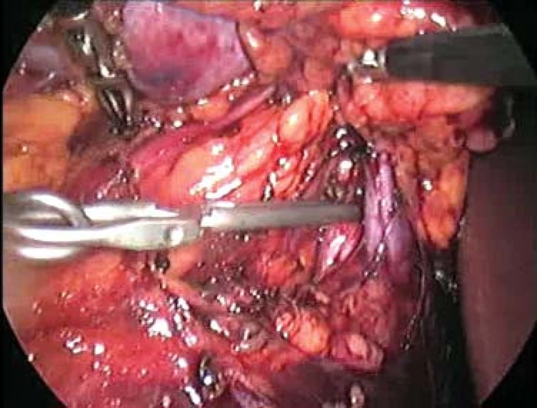 Cévní svorka in situ. Vpravo je okraj jater, nahoře ledvina přidržovaná dvěma graspery, svorka klampuje renální arterii, před ní je renální žíla. Obrázek je nízké kvality (0,8 M pixel), neboť je získán z videozáznamu.
