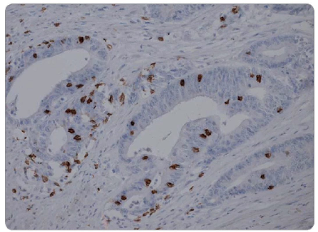 Vysoká hustota CD8<sup>+</sup> TIL chirurgickém resekátu, imunohistochemická pozitivita CD8, zvětšeno 200x.