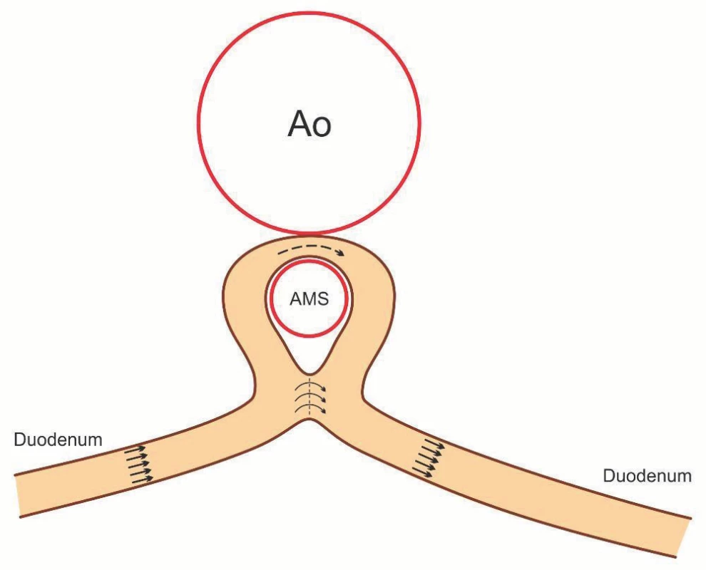 Schematické znázornění – duodeno-duodeno anastomóza side-to-side.
Fig. 4. Morphology of duodeno-duodeno anastomosis side-to-side.