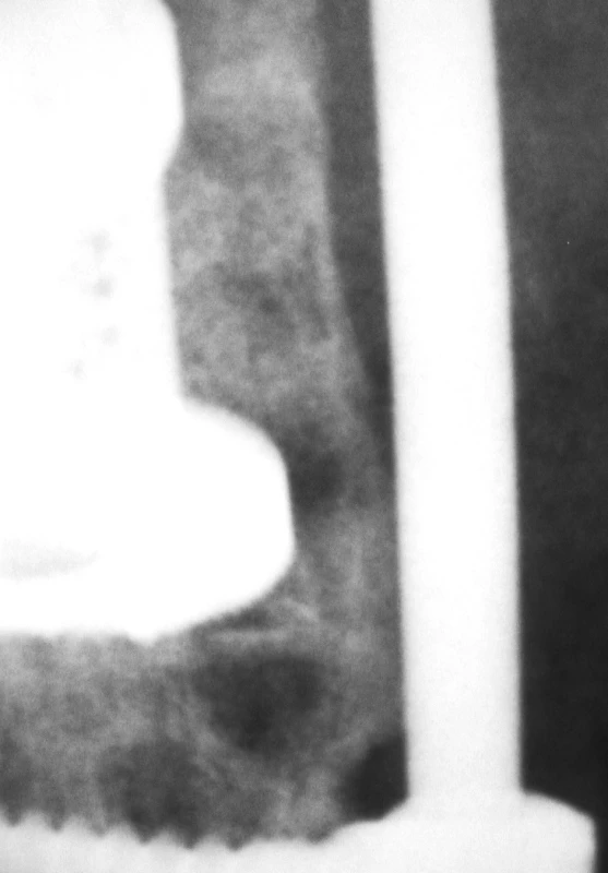 Intersomatická fúze, detail
Pic. 6. Intersomatic fusion, a detailed view