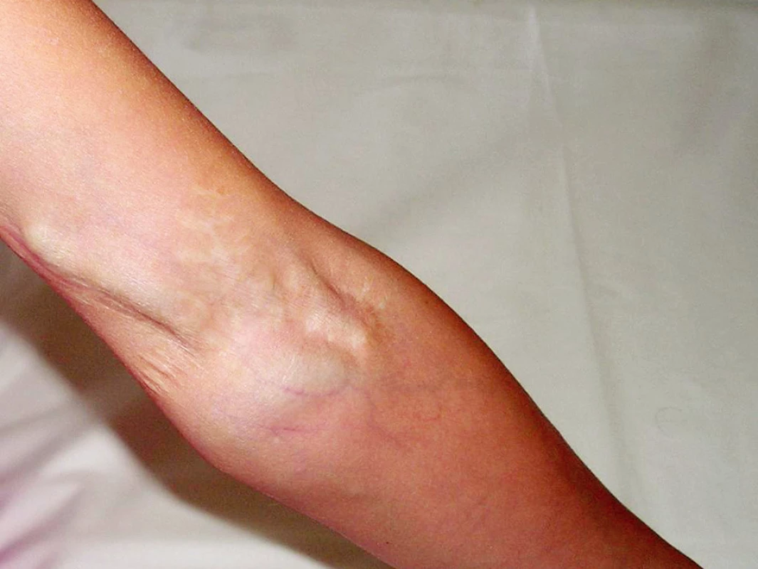 Klinický nález brachiocefalickej fistuly
Fig. 2. Clinical finding of a brachiocephalic fistula