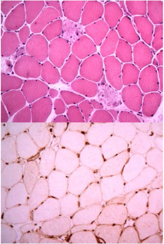 Histologický nález u imunitně zprostředkované nekrotizující myopatie a anti-HMGCR protilátkami:
a) nekrotická svalová vlákna bez zánětlivé infiltrace makrofágy (barvení hematoxylin a eozin),
b) hyperexprese molekul HLA I na povrchu svalových vláken u IMNM.