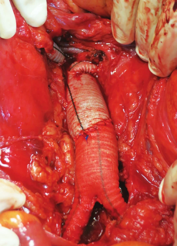 Kompletní rekonstrukce, bypass na AMS a levou renální tepnu a ABF bypass
Fig. 16: Complete reconstruction, bypass to SMA and left renal artery and ABF bypass