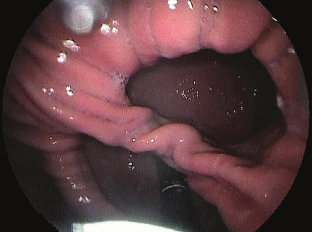„Double ring“ fenomén při endoskopii
Fig. 12: “Double ring phenomenon“ during endoscopy
