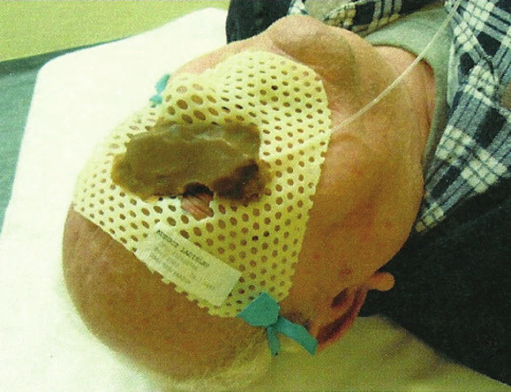 Naznačenie cieľového objemu (červená farba) a šošovky (zelená farba) na orfitovej maske