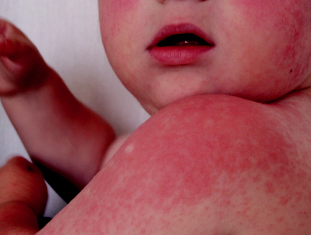 Gianotti-Crosti syndrome, 4-ročné dievča