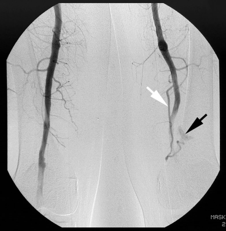 Digitální subtrakční angiografie levé dolní končetiny. Bílá šipka označuje větev arteria femoralis superficialis zásobující reziduum popliteálního aneuryzmatu (černá šipka).
Pic. 8. Digital subtraction angiography of left lower extremity. White arrow marks the branch of superficial femoral artery feeding the residual popliteal aneurysm (black arrow).