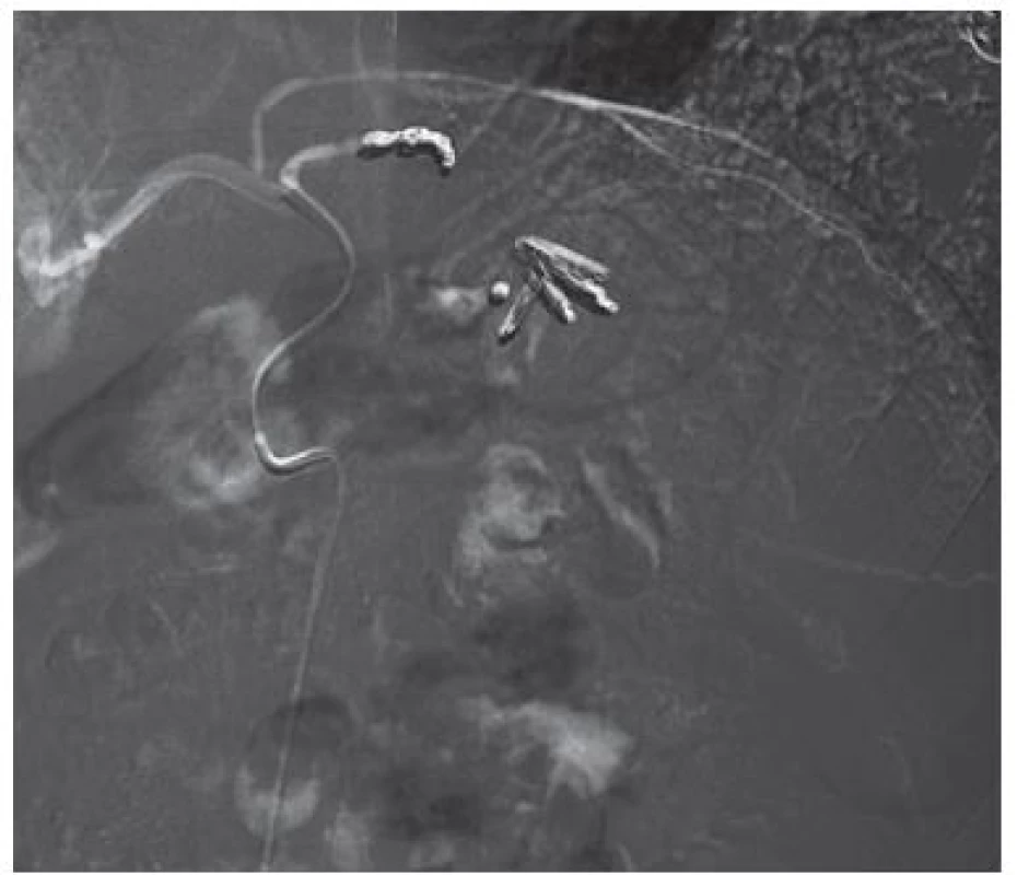 Vaskulární intervence – selektivní arteriografie
s embolizací arteria gastrica sinistra a arteria lienalis.
Zdroj: MUDr. Jiří Novotný Ph.D., Pracoviště radiodiagnostiky
a intervenční radiologie, IKEM.<br>
Fig. 2. Vascular intervention – selective arteriography with
embolization of arteria gastrica sinistra and arteria lienalis.
Source: Jiri Novotny M.D., Ph.D., Radiology and Intervention
radiology, IKEM.