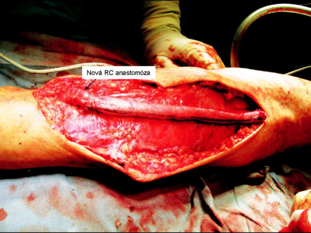 Nová radiocefalická anastomóza
Fig. 8. New radiocephalic anastomosis