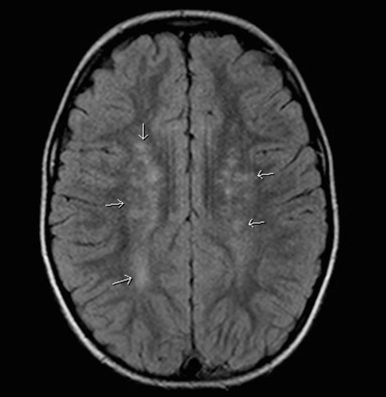 MR mozku, axiální zobrazení, FLAIR sekvence: Hypersignální ložiska v bílé hmotě mozku oboustranně frontoparietálně.
Fig. 2. MR of the brain, axial representation, FLAIR sequence: hypersignal foci in white matter of the brain bilaterally in frontal-parietal representation.