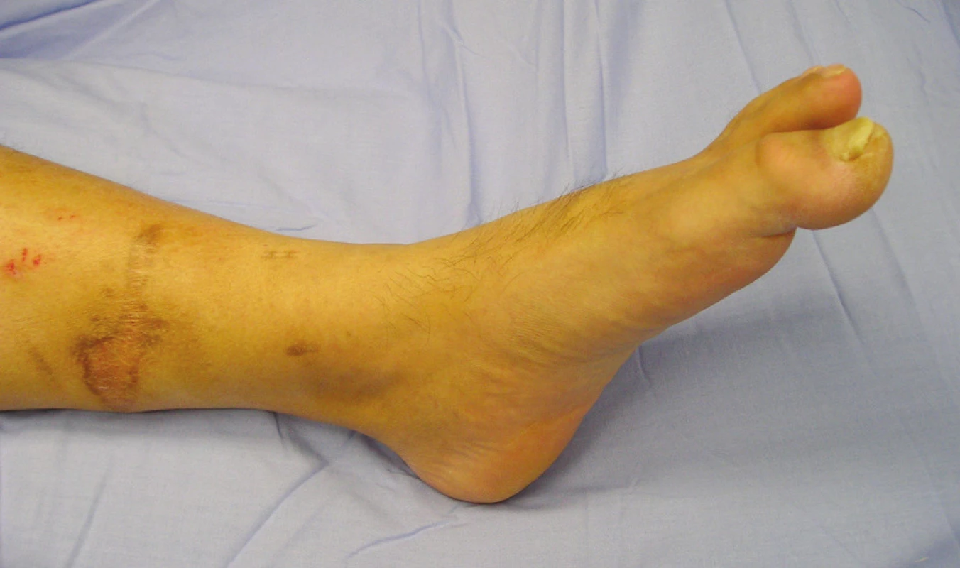 Pretrvávanie hallux flexus v plantárnej flexii v členkovom zhybe
Fig. 2. Hallux flexus, persisting during the joint´s plantar flexion