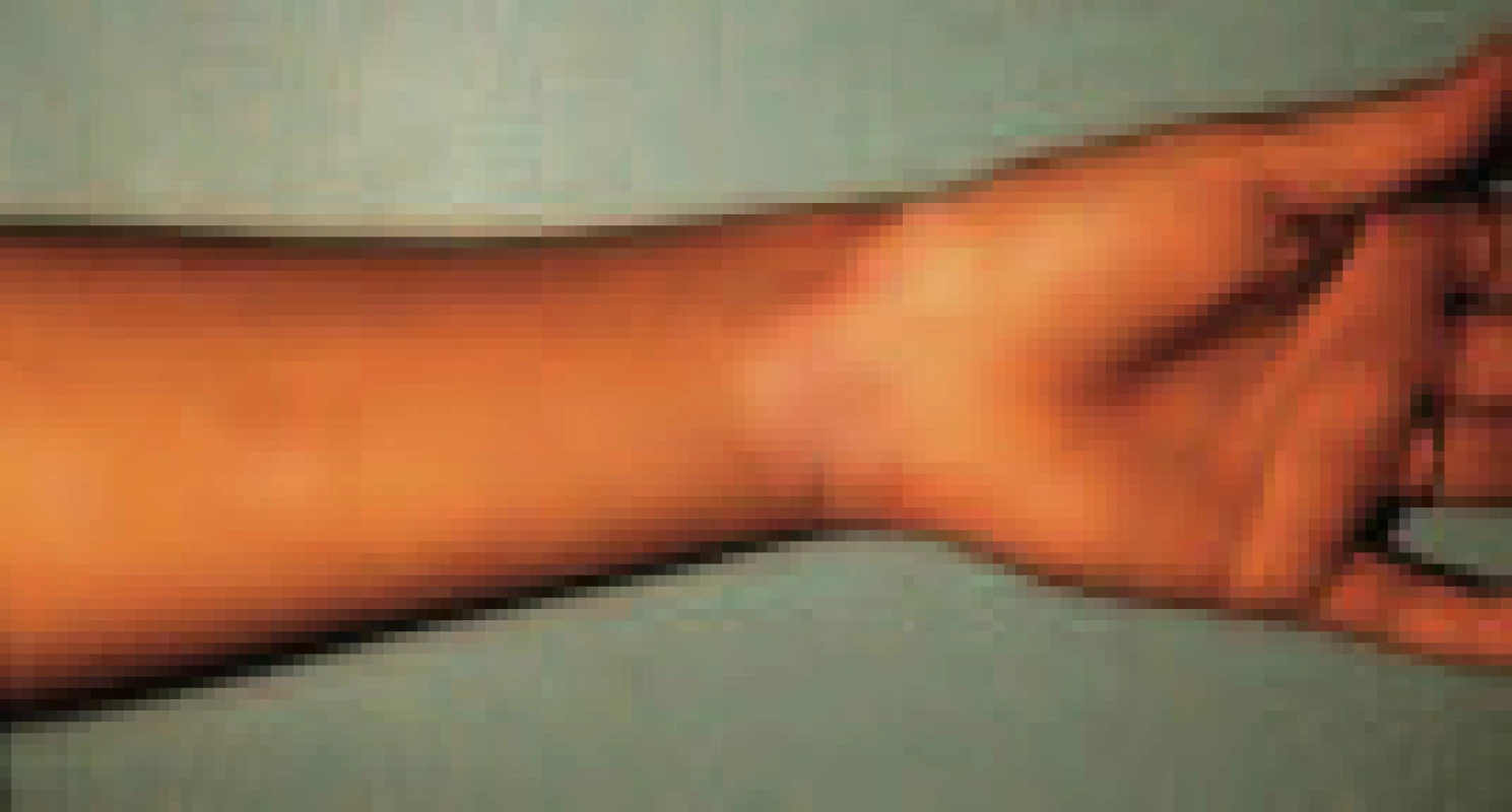 Vitiligo.