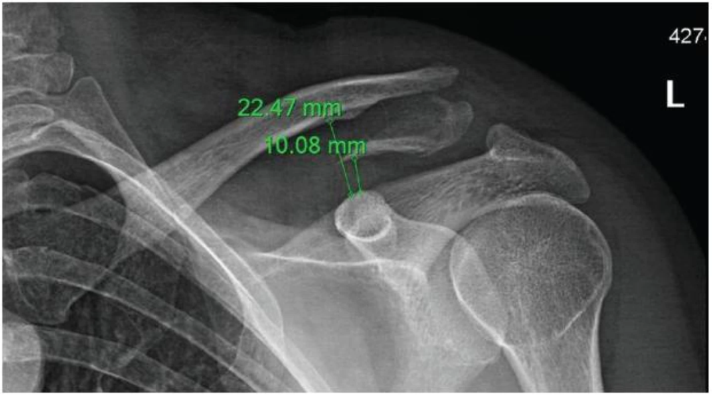 Zlomenina klíčku Neer IIb, lig. trapezium pevné, lig. conoideum přerušené
Fig. 5: Neer IIb clavicle fracture, lig. trapezium intact, lig.conoideum disrupted