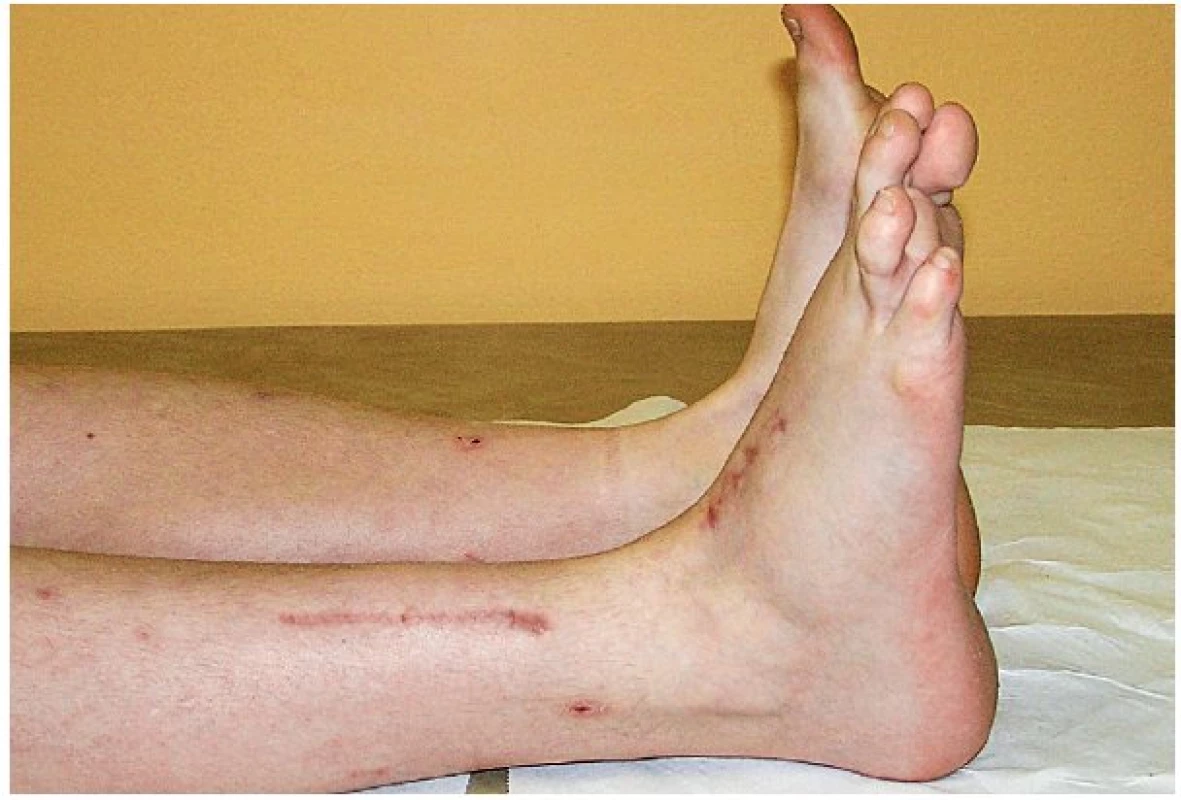 Stav za 5 měsíců po šlachové transpozici m. tibialis posterior za účelem obnovy extenze pravého nártu u chlapce z obrázku č. 8. Při této operaci je šlacha m. tibialis posterior odpojena od svého úponu na mediální straně nártu, protažena proximálně do oblasti mediálního bérce, protunelizována přes interoseální membránu mezi tibií a fibulou a po provlečení pod extenzorovými retinakuly ukotvena na dorsum nártu. Tím dojde k částečné substituci role nefunkční šlachy m. tibialis anterior.