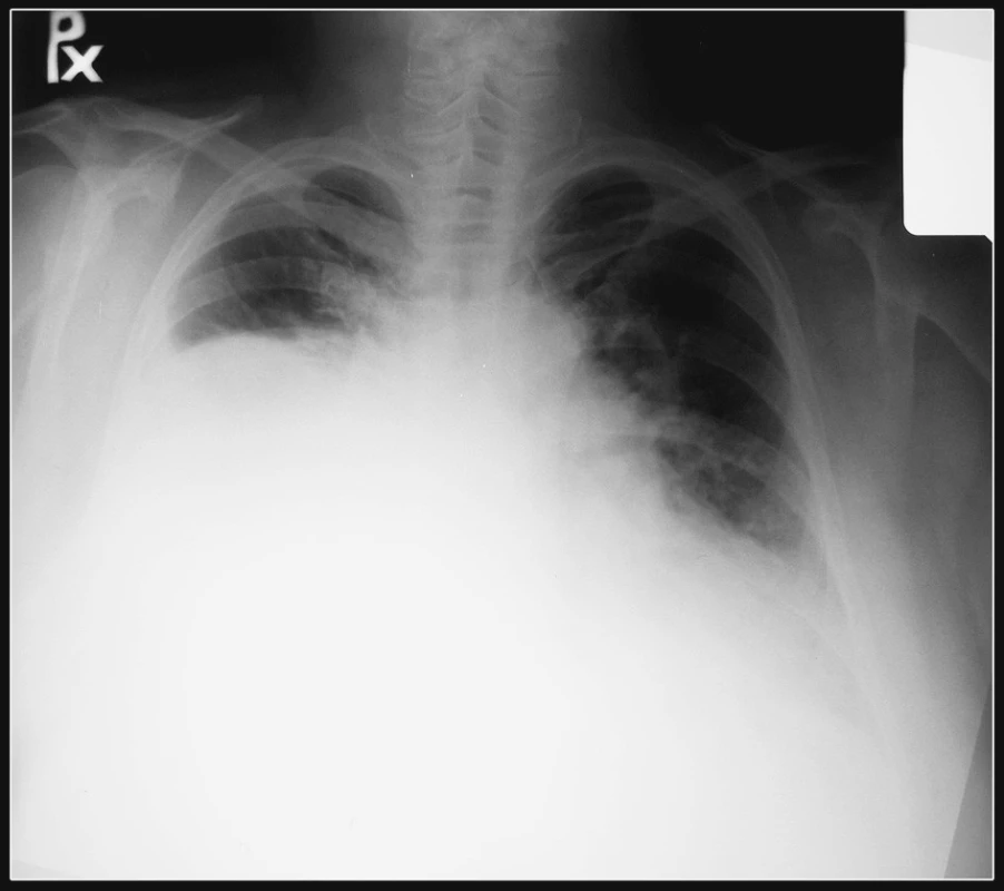 RTG snímka pacienta pred operáciou poukazujúca na zatienenie pravej hrudníkovej dutiny s ostrým ohraničením vo výške tretieho rebra
Fig. 1. The patient’s chest x-ray prior to the procedure, showing a density in the right thoracic cavity with a well-defined outline at the third rib-level