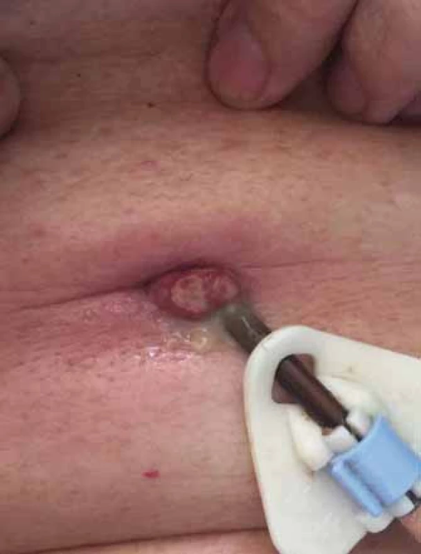 Granulomatózní komplikace v místě PEG jejunální sondy.
Fig. 1. Hypergranulomatosis complication in place of jejunal PEG insertion.