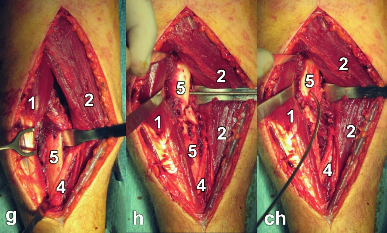 Henryho přístup: a – linie kožního řezu, b – preparace v podkoží, šipka ukazuje n. cutaneus antebrachii lat., c – stav po protětí fascie; d – identifikace m. brachioradialis, e – preparace v intervalu mezi m. brachioradialis a m. flexor carpi radialis, f – identifikace m. pronator teres; 
g – preparace distálního úlomku radia s úponem m. pronator teres; h – preparace proximálního úlomku; ch – supinace proximálního úlomku pomocí K-drátu: 1 – m. brachioradialis, 2 – m. flexor carpi radialis, 3 – a. radialis, 4 – šlacha m. pronator teres, 5 – radius.
Fig. 9: Henry approach: a – skin incision line, b – subcutaneous dissection, the arrow indicates lateral cutaneous nerve of forearm, c – split fascia; d – identification of brachioradialis, e – dissection in the interval between brachioradialis and flexor carpi radialis, f – identification of pronator teres; g – dissection of the distal fragment of radius with insertion of pronator teres; h – dissection of the proximal fragment; ch – supination of the proximal fragment by K-wire: 1 – brachioradialis, 2 – flexor carpi radialis, 3 – radial artery, 4 – pronator teres tendon, 5 – radius.
