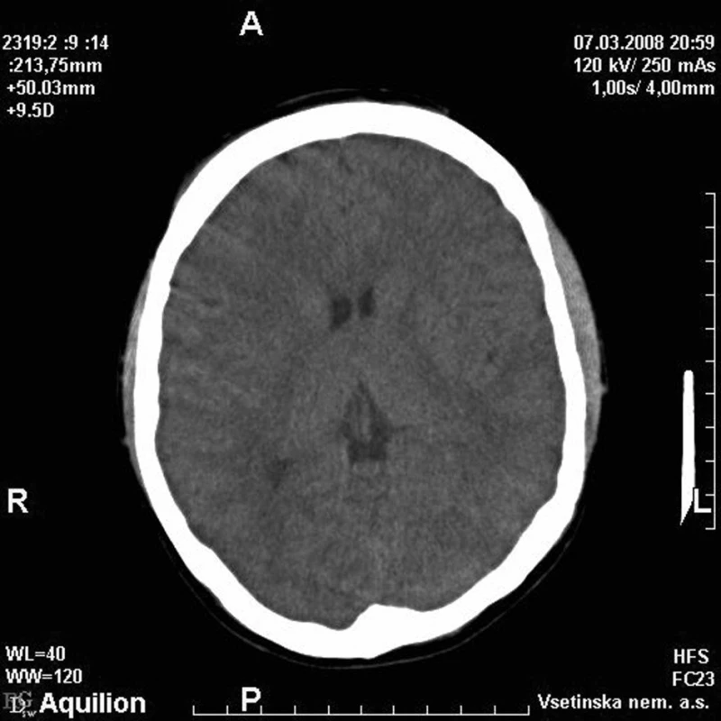 Nativní CT mozku brzy po úrazu 
Fig. 1. Early posttraumatic native brain CT images