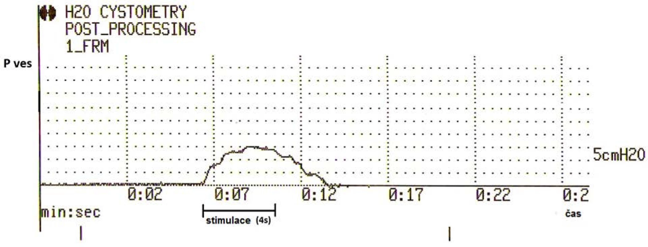 Záznam cystometrie – zvýšení intravezikálního tlaku v průběhu stimulace
Fig. 6. Cystometry – intravesical pressure elevation in stimulation process